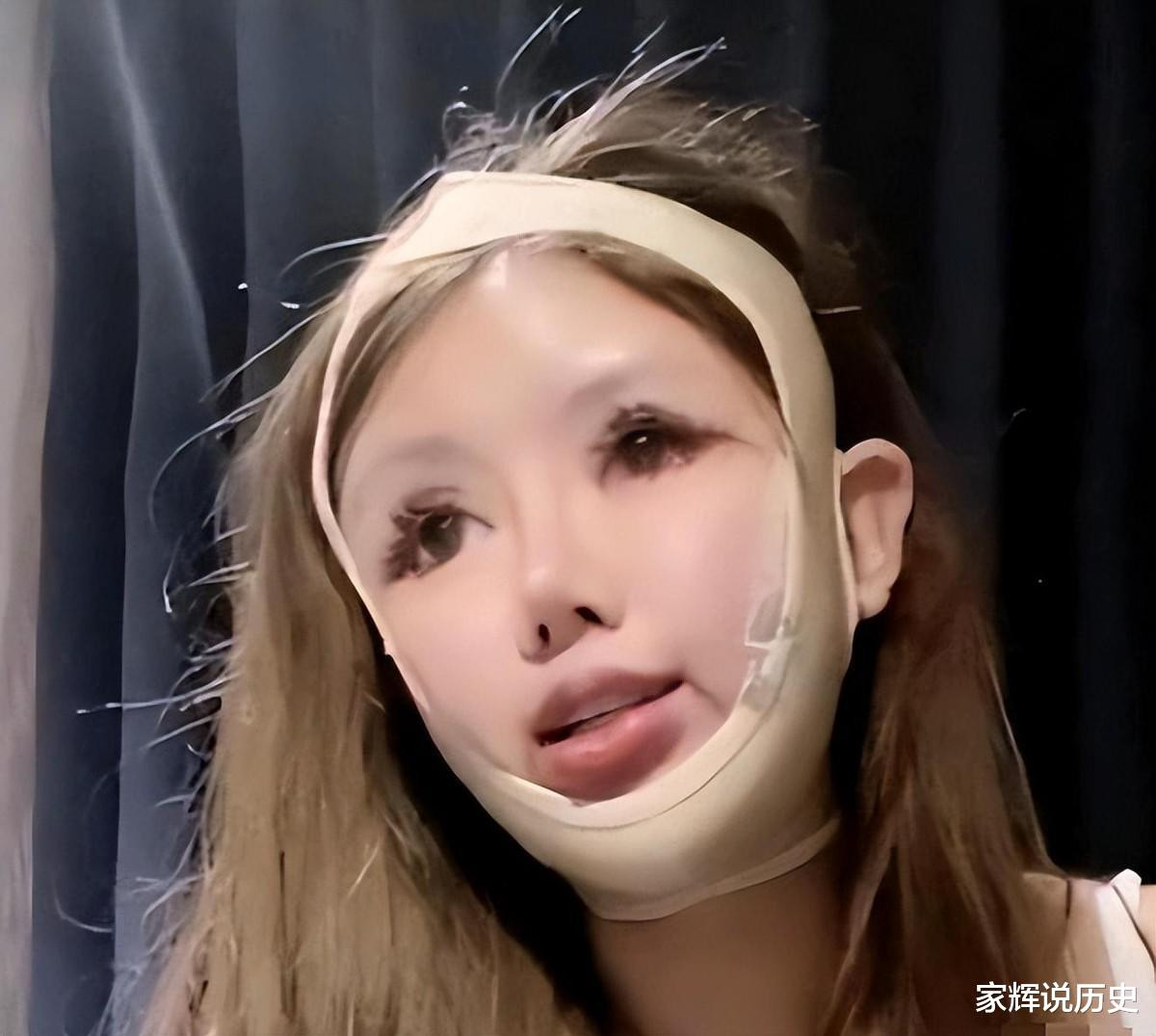 Sau khi mở khóe mắt dưới và tỉnh lại vào ngày hôm sau, Chu Sở Na thấy mắt mình đầy máu và nước mắt, vì vậy cô vội vàng liên lạc với bác sĩ, câu trả lời cô nhận được là khóe mắt quá mở, chỉ có thể đợi vết thương từ từ lành lại.