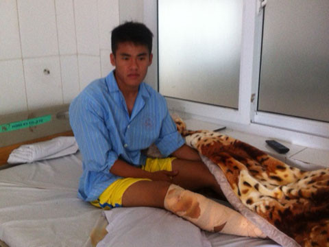 Kết quả chụp phim cho thấy, Anh Hùng bị gãy xương ống chân.