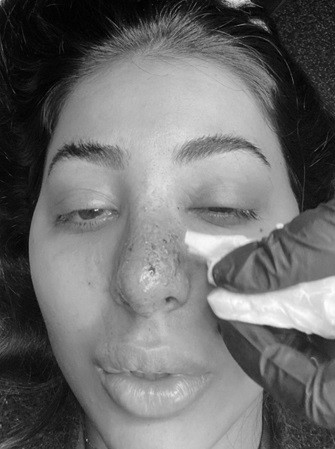 Trước đó, Aneesa tiêm filler (chất làm đầy) để định hình lại sống mũi. Tuy nhiên vì chọn loại kém chất lượng nên người mẫu gốc Anh này gặp tình trạng filler tắc nghẽn làm máu không thể lưu thông, dẫn đến vùng mũi bị hoại tử.