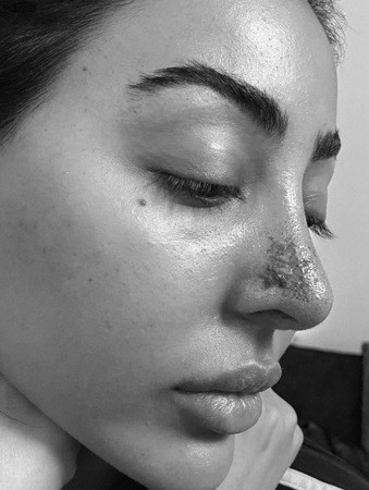 Mới đây, Aneesa cảnh báo về rủi ro tiêm filler sau khi suýt mất mũi. Trang The Sun đưa tin, cô nàng nhập viện trong tình trạng mặt tím tái vì thiếu oxy.