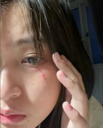 Trong một số tấm hình do Thảo Tâm chia sẻ, đôi mắt của cô sau bị mèo cào đã trở nên sưng to. Phần da mắt lộ rõ vết cào và đỏ ửng.