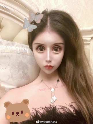 Về chi phí, Tiểu Z Na Na tiết lộ số tiền để mài khung xương là 200 nghìn NDT (khoảng 664 triệu VND). Cô cho biết, ngoại trừ hộp sọ thì toàn bộ xương trên cơ thể mình đều đã trải qua những cuộc phẫu thuật thẩm mỹ.