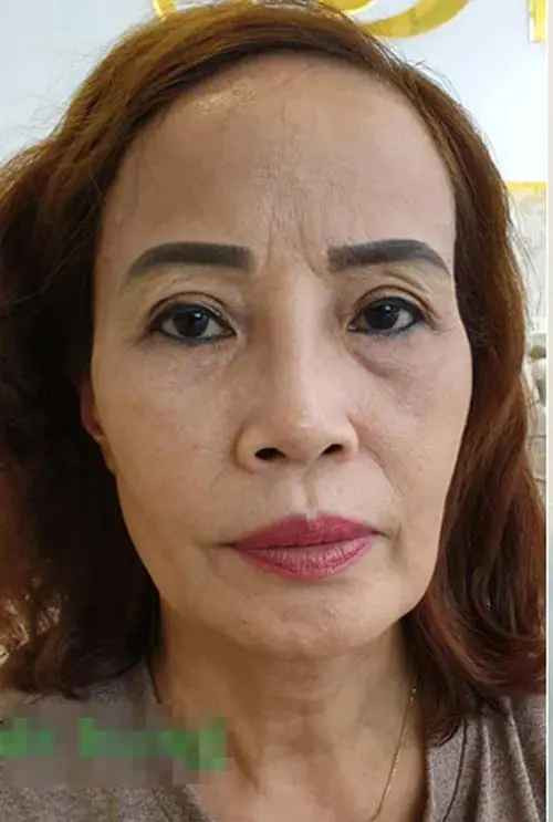 Để khắc phục những vết hằn của năm tháng, cô dâu Thu Sao đã phải can thiệp bằng phẫu thuật thẩm mỹ.