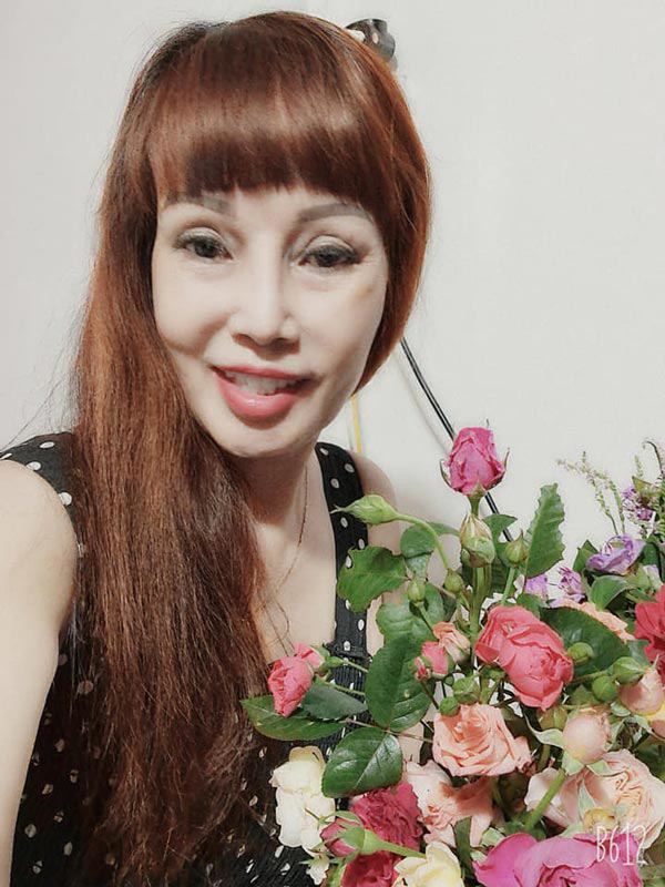 Do tuổi tác đã cao nên cô Thu Sao cũng bị di chứng do phẫu thậm thẩm mỹ để lại.