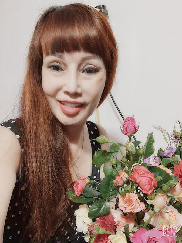 Do tuổi tác đã cao nên cô Thu Sao cũng bị di chứng do phẫu thậm thẩm mỹ để lại.