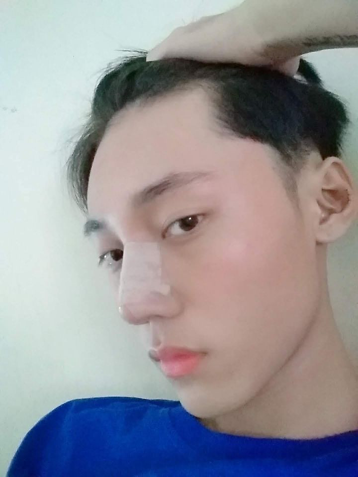 Sau màn phẫu thuật thẩm mỹ thành công, chàng trai Hoài Thương xấu xí ngày nào đã lột xác hoàn toàn, biến thành hot boy "vạn người mê".