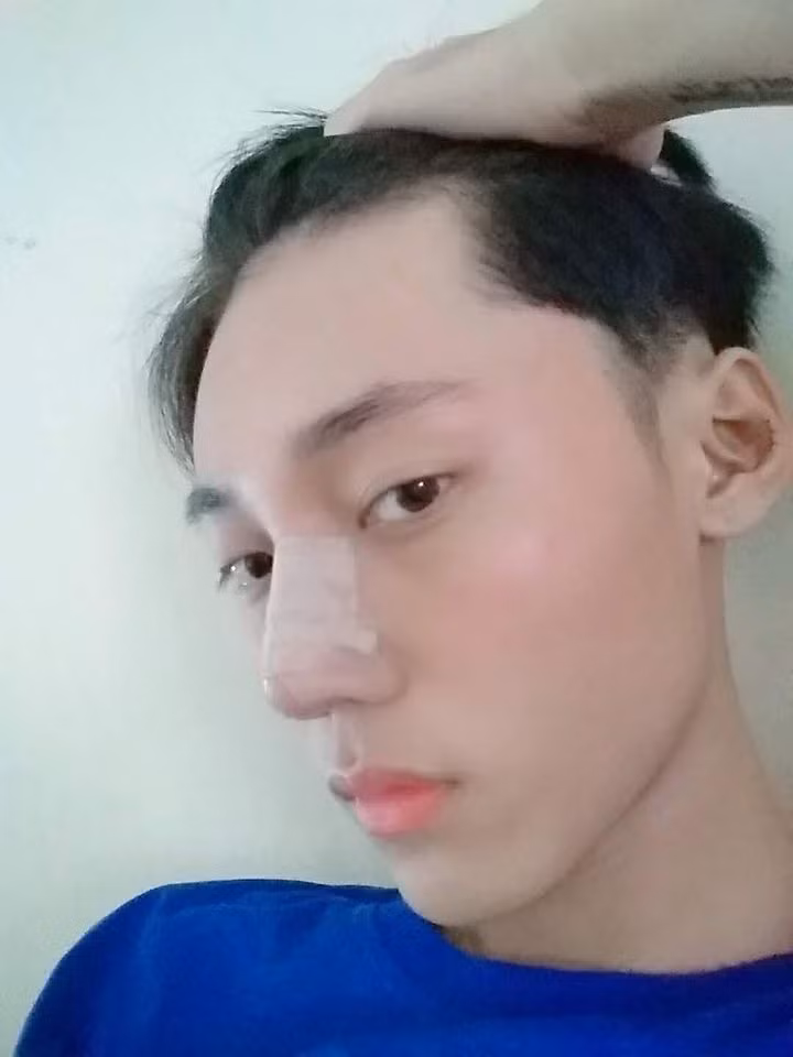 Sau màn phẫu thuật thẩm mỹ thành công, chàng trai Hoài Thương xấu xí ngày nào đã lột xác hoàn toàn, biến thành hot boy "vạn người mê".