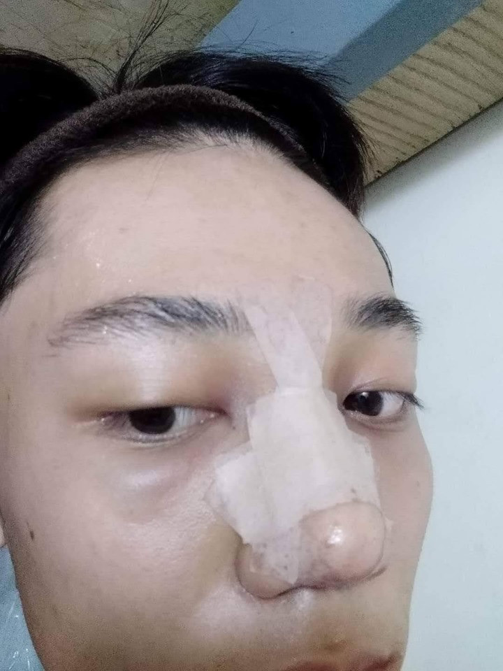 Để bắt đầu cuộc phẫu thuật thẩm mỹ của mình, Hoài Thương đã bỏ ra khoảng 70 triệu đồng để nâng mũi gồm sụn nhân tạo và bọc đầu mũi bằng sụn tự thân, tiêm má bằng filler…