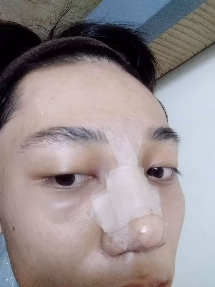 Để bắt đầu cuộc phẫu thuật thẩm mỹ của mình, Hoài Thương đã bỏ ra khoảng 70 triệu đồng để nâng mũi gồm sụn nhân tạo và bọc đầu mũi bằng sụn tự thân, tiêm má bằng filler…