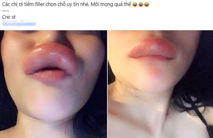  Tiêm filler môi là một phương pháp thẩm mỹ quen thuộc đối với nhiều chị em.