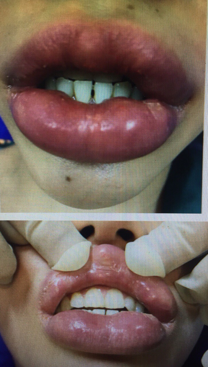 Người này phải nhận về đôi môi biến chứng cả đời.