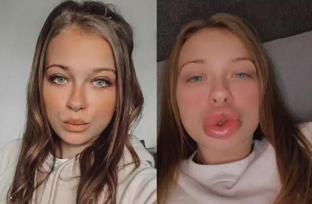 Bên cạnh đó, khách hàng cũng cần được tư vấn các biến chứng có thể xảy ra và các hướng xử trí khi cần thiết sau khi sử dụng phương pháp làm đẹp bằng filler.