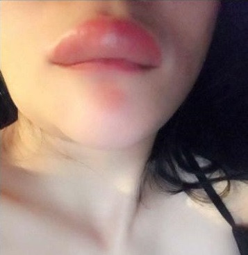 Song bên cạnh đó, phương pháp tiêm filler cũng gây ra không ít biến chứng như sưng đau, biến dạng.