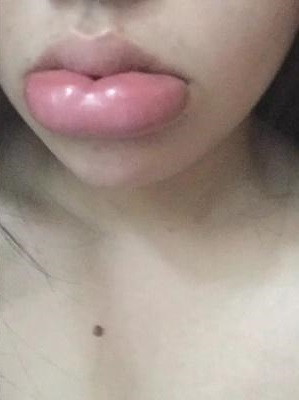 Đính kèm, người này cảnh báo những ai đang và có ý định tiêm môi: "Các chị ơi tiêm filler chọn chỗ uy tín nhé. Môi mọng quá thể".