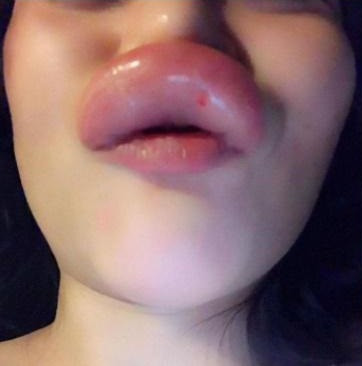 Phương pháp tiêm filler mang lại công dụng tuyệt vời, cải thiện làn da, xóa nhăn, làm trắng, trẻ hóa hay tạo hình thẩm mỹ như nâng mũi, môi trái tim...