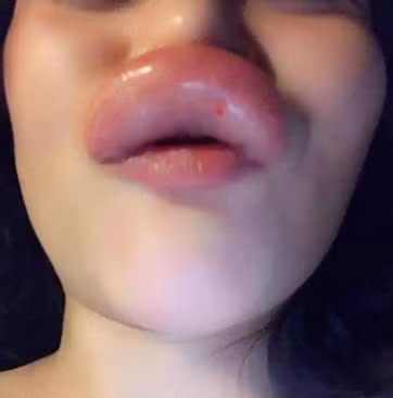 Phương pháp tiêm filler mang lại công dụng tuyệt vời, cải thiện làn da, xóa nhăn, làm trắng, trẻ hóa hay tạo hình thẩm mỹ như nâng mũi, môi trái tim...