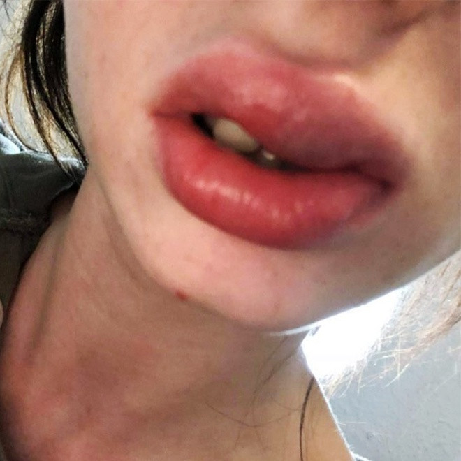 Khi có biến chứng cần đến các cơ sở y tế tuyến cao, có giấy phép hành nghề để xử trí, tránh biến chứng gây hậu quả xấu về thẩm mỹ.