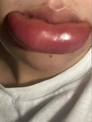Mới đây, một cô gái đã chia sẻ hình ảnh bờ môi sau khi tiêm filler. Nhìn ảnh ai cũng phải "ngã ngửa" với đôi môi sưng phồng, to như trái cà chua.