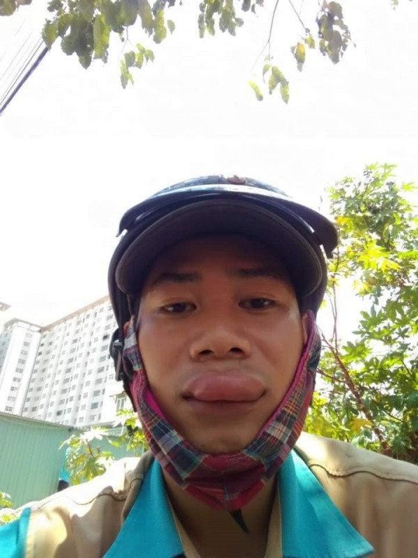 Màn bị ong đốt bất ngờ khiến bờ môi của anh chàng sưng tều lên thành mảng lớn.