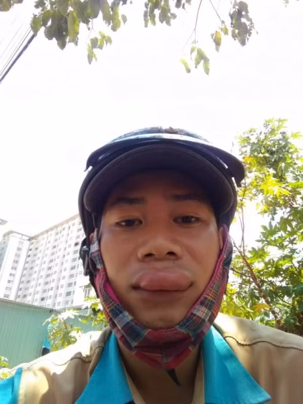 Màn bị ong đốt bất ngờ khiến bờ môi của anh chàng sưng tều lên thành mảng lớn.
