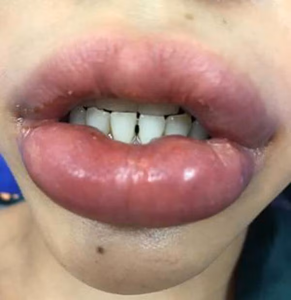 Nhìn khuôn mặt đáng thương của anh thợ sửa mạng sau khi bị ong chích khiến dân tình cười ra nước mắt trước tình huống éo le này.