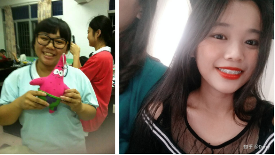 Dù đang niềng răng nhưng bạn có công nhận là giảm cân một cái, nhan sắc cô bạn này cũng lên hương không?