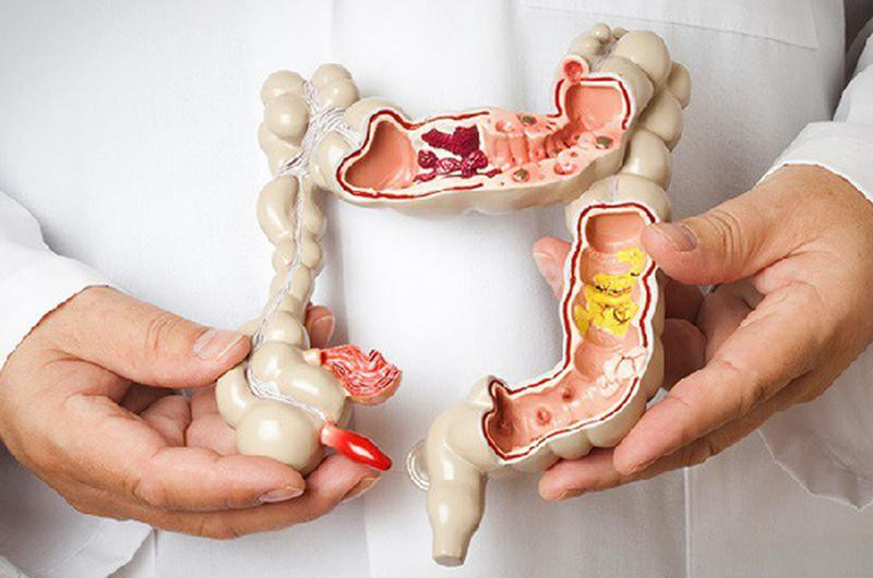 Các loại rau này rất giàu chất xơ, có thể làm mềm phân, kích thích nhu động ruột, đẩy nhanh quá trình thải phân và khiến các chất gây ung thư trong phân được thải ra kịp thời, do đó nó có tác dụng ngăn ngừa ung thư đường ruột.