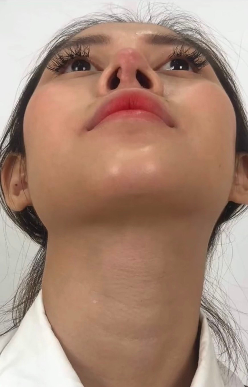 Nhờ tân trang, sóng mũi của Việt Phương Thoa giờ đã cao hơn, cánh mũi cũng hẹp hơn, đường nét gương mặt hài hòa.