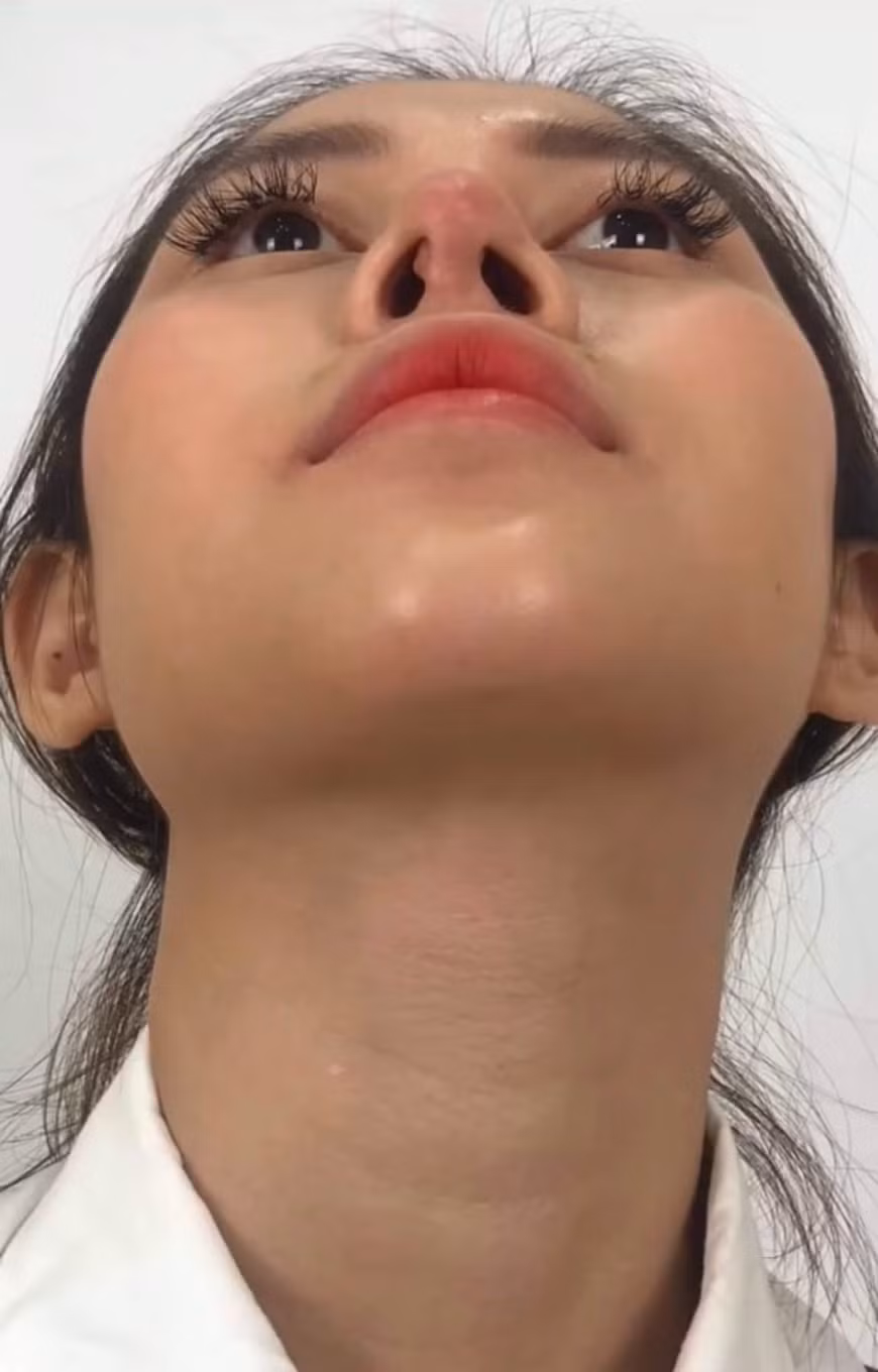 Nhờ tân trang, sóng mũi của Việt Phương Thoa giờ đã cao hơn, cánh mũi cũng hẹp hơn, đường nét gương mặt hài hòa.