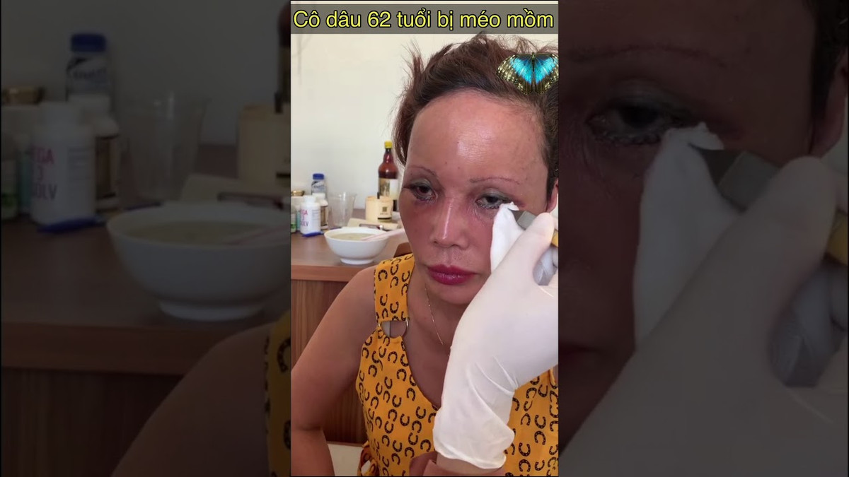 Hiện tại cuộc đại phẫu được hơn 1 tuần vợ chồng cô dâu 62 tuổi chia sẻ sẽ ở lại Hà Nội đến khi cắt chỉ, vết thương lành rồi mới về lại Cao bằng.