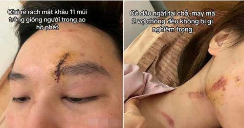 “Ngày cưới cũng là ngày kinh hoàng nhất với hai vợ chồng tôi. Hôm đó khoảng 12 giờ kém, trên đường đưa dâu về nhà chồng thì xe hoa của chúng tôi gặp tai nạn. Lúc đó tôi chỉ nhớ thoáng qua trong đầu có một chiếc xe ô tô tải trước mắt, sau đấy mở mắt ra, tôi thấy mặt chồng đầy máu me. Cứ ngỡ là nằm mơ, tôi còn hỏi: ‘Ơ, mặt anh bị làm sao thế…’. Và rồi mở mắt ra lần nữa lại thấy bác sĩ gọi tên, cứ tiếng to tiếng nhỏ bên tai: ‘Cho vào chụp đi’. Mở to mắt ra nhìn, tôi thấy xung quanh bao nhiêu bệnh nhân tai nạn cấp cứu nằm bên cạnh, nhìn xuống thấy mình vẫn đang mang váy cưới to đùng, trên váy cưới còn dính máu”, chị Phương Trinh nhớ lại giây phút kinh hoàng đó.