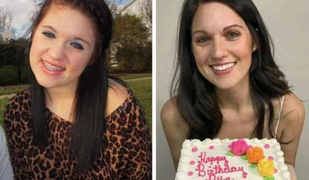 Với nhiều người, tuổi dậy thì của họ thực sự chỉ bắt đầu khi tháo niềng răng.