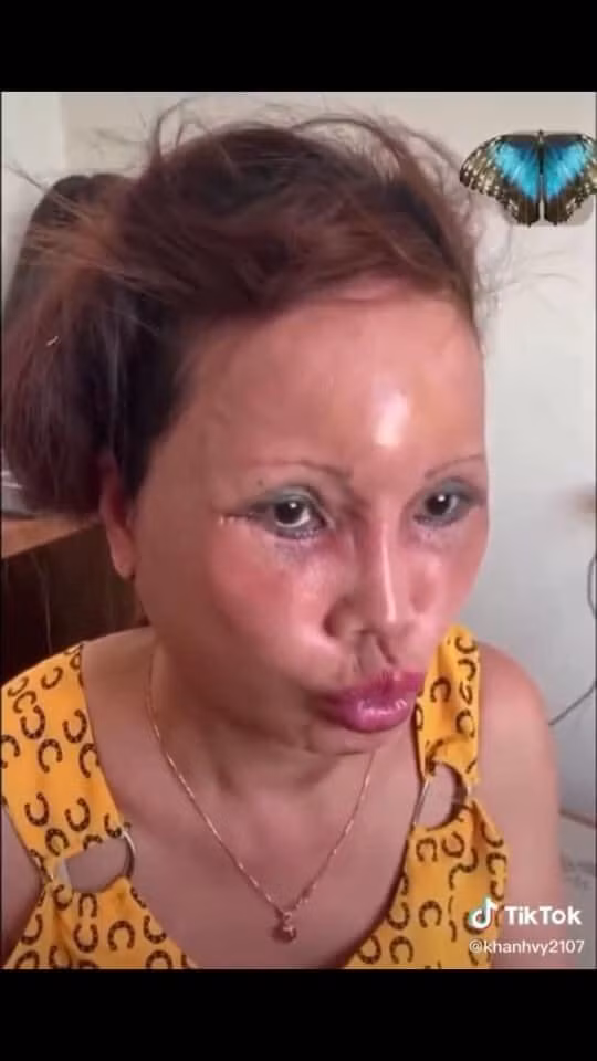 Mới đây, cô dâu 62 tuổi tên Thu Sao liên tục cập nhật hình ảnh mới nhất của mình đến mọi người. Thế nhưng, thay vì háo hức, cư dân mạng bày tỏ lo lắng thậm chí sốc nặng khi gương mặt chị Sao vừa sưng, vừa biến dạng.