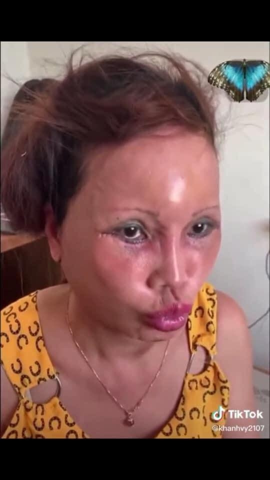 Mới đây, cô dâu 62 tuổi tên Thu Sao liên tục cập nhật hình ảnh mới nhất của mình đến mọi người. Thế nhưng, thay vì háo hức, cư dân mạng bày tỏ lo lắng thậm chí sốc nặng khi gương mặt chị Sao vừa sưng, vừa biến dạng.