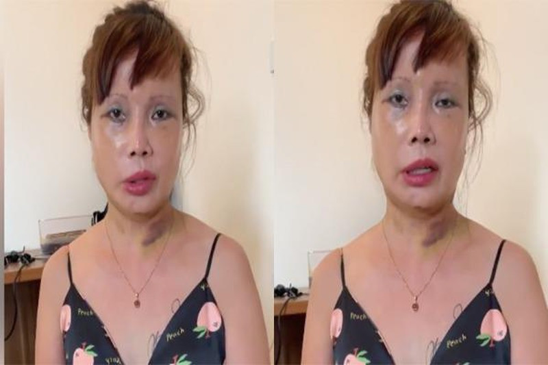 Nhìn mặt cô dâu Thu Sao, nhiều người đã dự đoán đó là di chứng của phẫu thuật và rất khó để hồi phục lại như ban đầu.