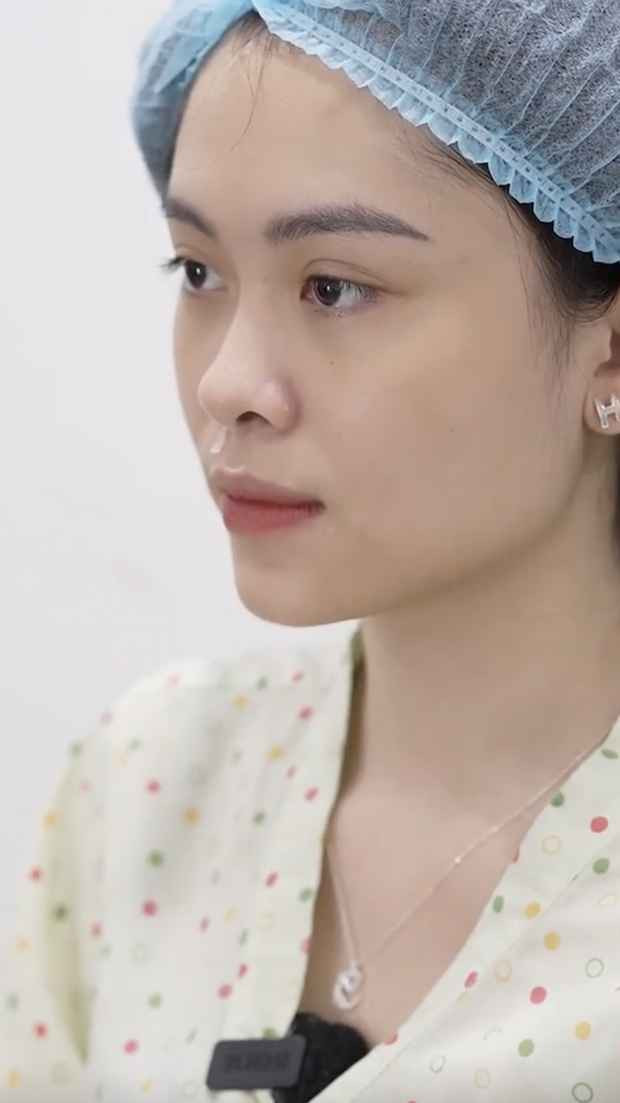 Ngân Hà cũng từng công khai chỉnh sửa nhan sắc như nâng mũi, tiêm filler,... nhờ vậy mà cô nàng có gương mặt cân đối hơn.