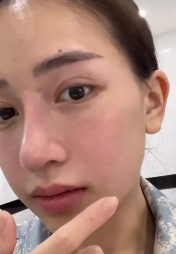 "Người quay video trên TikTok quay xấu kinh khủng, ánh đèn chiếu từ trên xuống, thấy nguyên cái sẹo ở ngay đây", Joyc Phạm nói thêm.