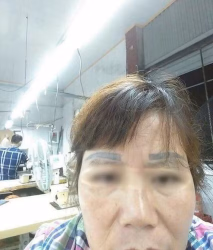 Vì tay nghề của thợ "non và xanh" khiến dáng lông mày quá khổ, chiếm một phần diện tích lớn ở trán của một người phụ nữ. Toàn bộ ca làm đẹp này giá 500 nghìn đồng.