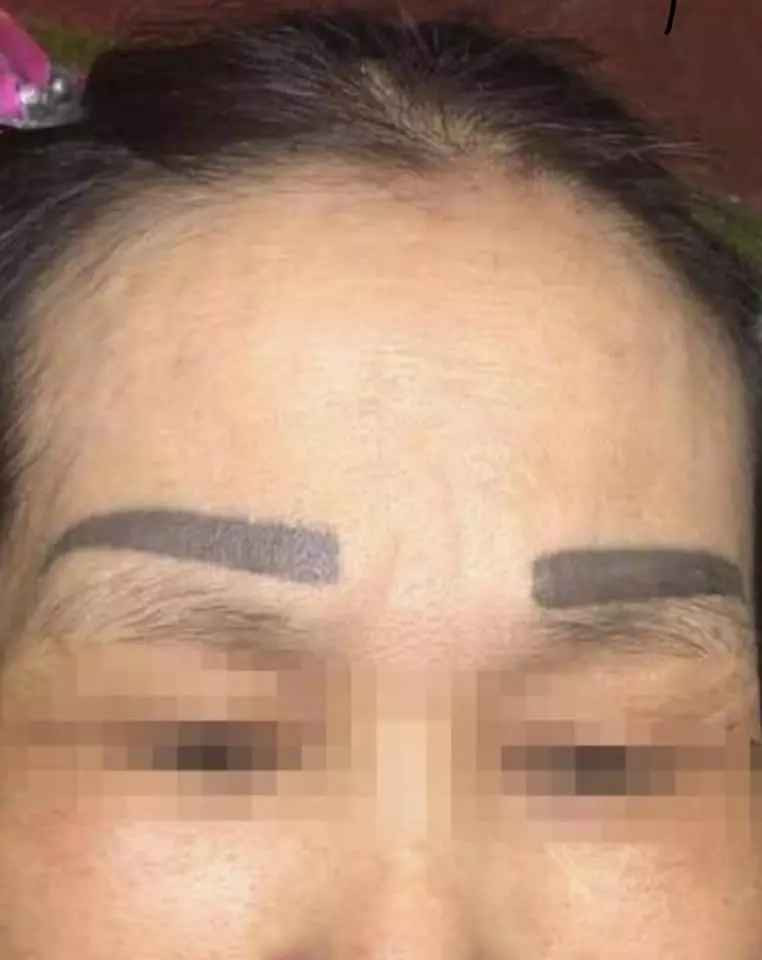 "Đây là một ca cấy lông mày có thể nói là khiến chị em trầm cẻm luôn sau vài ngày. Với trường hợp này, có lẽ chỉ còn cách cắt bỏ hết phần lông mày hỏng rồi phun lại. Bên cạnh đó cũng khuyên chị em nên thật sự cẩn trọng khi lựa chọn làm đẹp tại một cơ sở nào đó, đừng quá tin vào quảng cáo kẻo lại tiền mất tật mang", trích bài đăng trên diễn đàn.