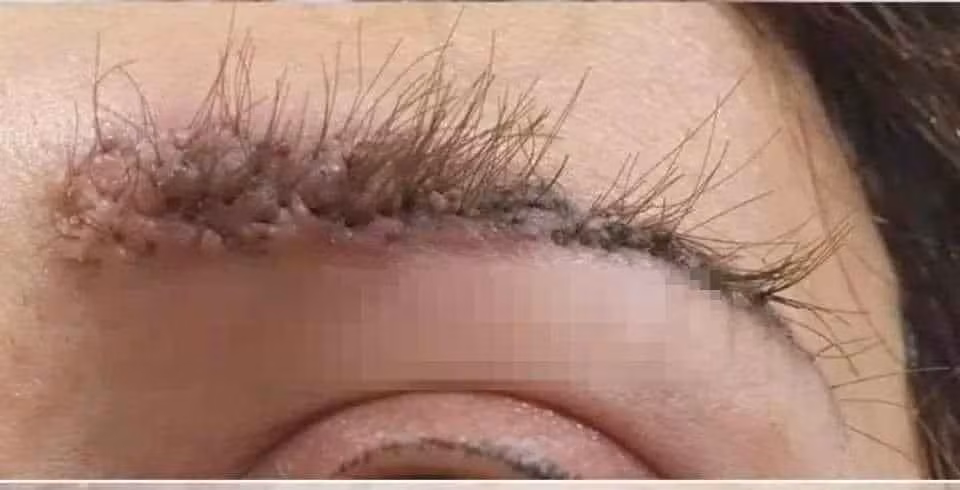 Đẹp chẳng thấy đâu khi toàn bộ khu vực xung quanh bị sưng tấy đỏ, lông mày thì cấy lởm chởm, không thành hàng lối.