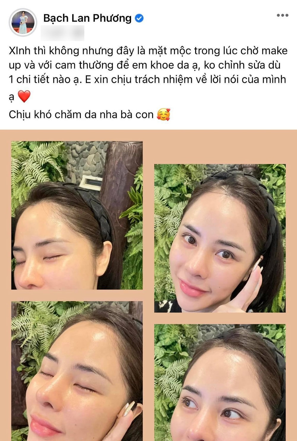 Theo đó, bạn gái Huỳnh Anh cho biết đã thực hiện nhấn mí vì không muốn sử dụng kích mí mà có một đôi mắt to, đẹp hơn.