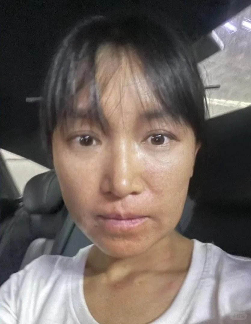 Tuy nhiên mới đây, trên MXH bất ngờ lan truyền hình ảnh mặt Lý Tử Thất bị biến dạng khi làm tranh sơn mài, phơi bày sự thật nhiều đau đớn phía sau chiếc tủ sơn mài độc đáo và những thước phim nên thơ của cô.