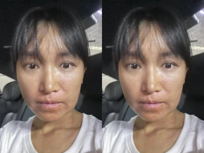 Trong hình ảnh này, “tiên nữ đồng quê” xuất hiện với gương mặt khá đáng sợ khi sưng phù, nổi mụn nước sần sùi và môi hơi sưng đỏ. Thậm chí nếu có người không nhận ra Lý Tử Thất cũng là điều dễ hiểu.