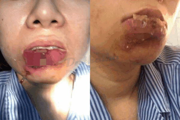 "Vị bác sĩ đó khiến tôi trông thật đáng sợ, tôi sẽ không bao giờ quay lại. Mọi người đừng sợ làm các thủ thuật làm đẹp như tiêm môi, chỉ cần cẩn thận khi chọn nơi làm là được", Burko nói trong clip. (Ảnh minh hoạ)