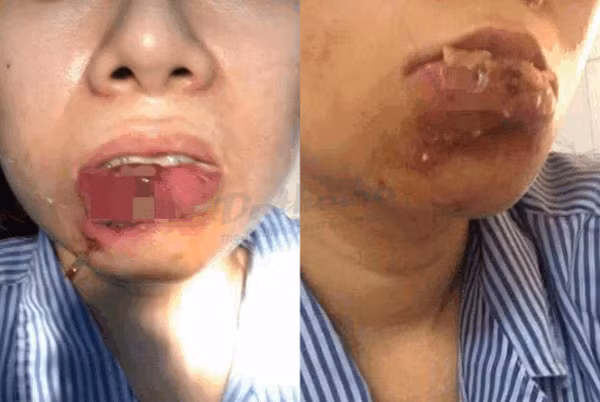 "Vị bác sĩ đó khiến tôi trông thật đáng sợ, tôi sẽ không bao giờ quay lại. Mọi người đừng sợ làm các thủ thuật làm đẹp như tiêm môi, chỉ cần cẩn thận khi chọn nơi làm là được", Burko nói trong clip. (Ảnh minh hoạ)