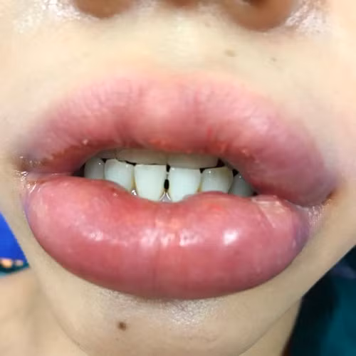 Tuy nhiên, sau khi về đến nhà, cô cảm thấy sự bất ổn đang ngập tràn trên đôi môi của mình. Burko quyết định quay trở lại phòng khám ngay sau đó, để yêu cầu bác sĩ kiểm tra. (Ảnh minh hoạ)