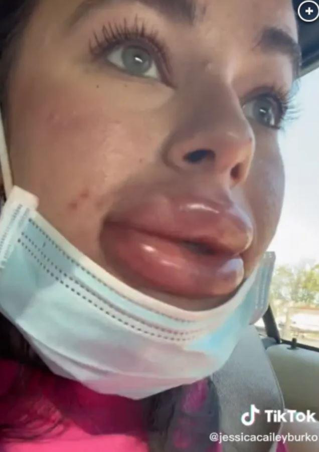 Theo chia sẻ của Burko, đây không phải lần đầu tiên cô tiêm filler môi. Lần cuối cô thực hiện thủ thuật này là khoảng 1 năm trước. "Đây là lần đầu tiên tôi tới chỗ này tiêm môi và chắc chắn cũng là lần cuối", cô nói.