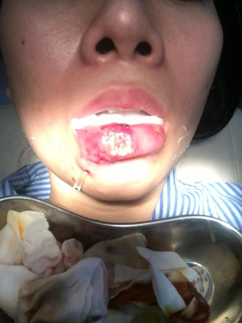 Đáng nói, sau khi được bác sĩ can thiệp chỉnh sửa, đôi môi của Burko vẫn không xẹp xuống mà thậm chí còn tồi tệ hơn. Cuối cùng, cô gái quyết định ngày hôm sau đến để tiêm tan filler. (Ảnh minh hoạ)