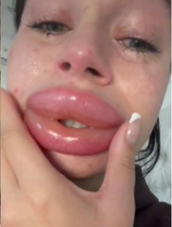 Theo đó, Jessica Burko cho biết vụ việc xảy ra vào giữa tháng 2. Cô trúng thưởng dịch vụ tiêm môi miễn phí trong một sự kiện giveaway (tặng quà) trước đó.