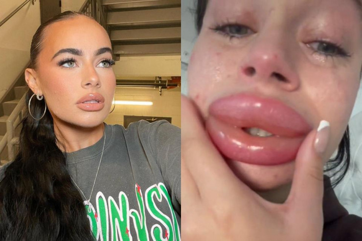 Mới đây, một TikToker (27 tuổi) sống tại Los Angeles đã chia sẻ sự việc kinh hoàng của cô khi ham hố sử dụng dịch vụ tiêm môi.